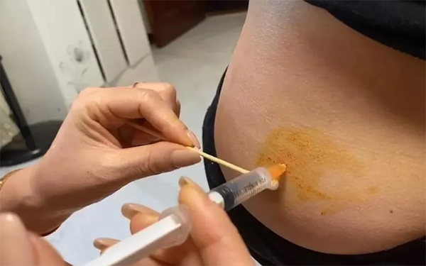 移植4bb的囊胚最好是进行自然周期还是人工周期？